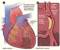 Obat Jantung Koroner Alami
